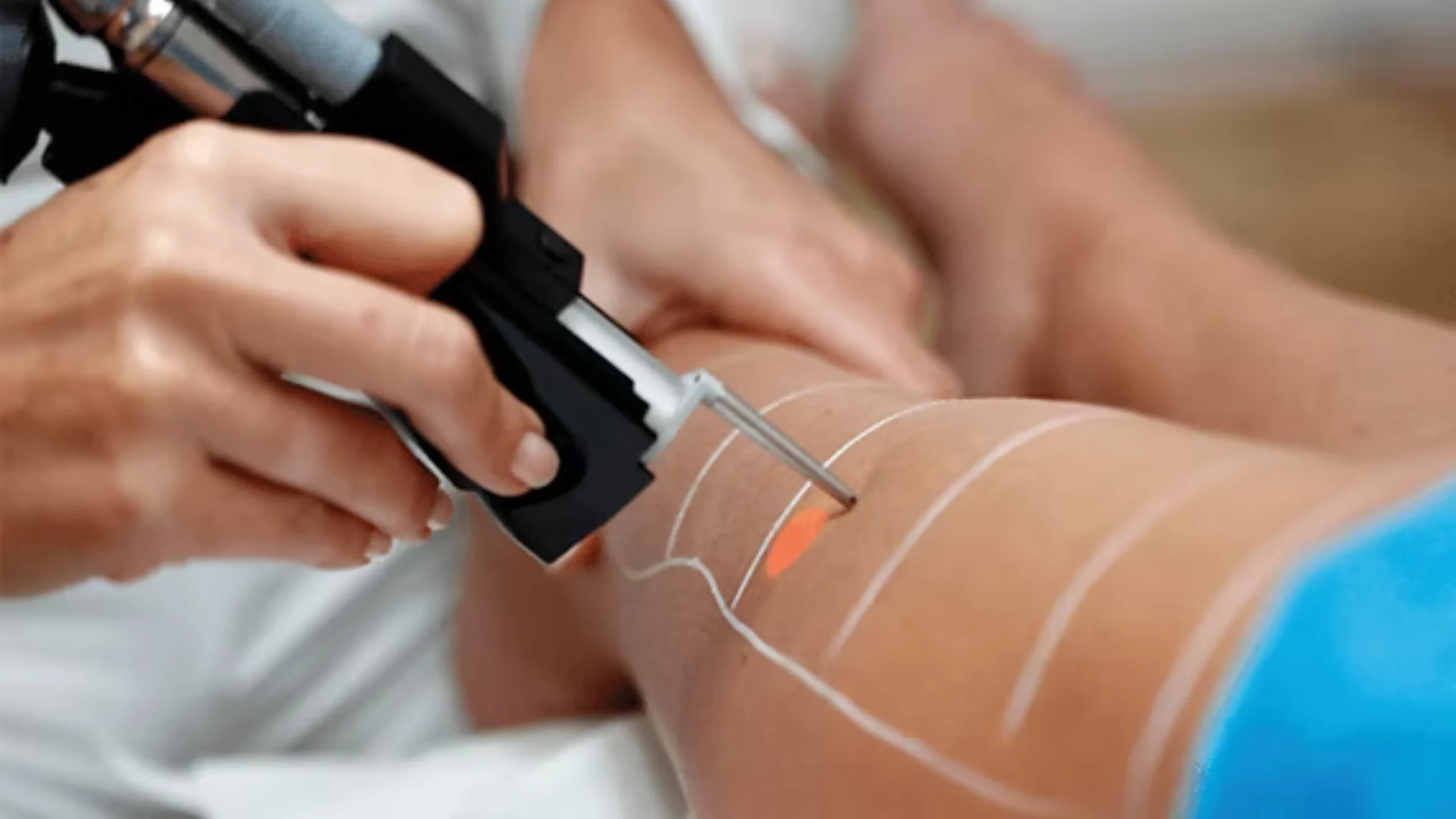 alexandrıte lazer epilasyon q result