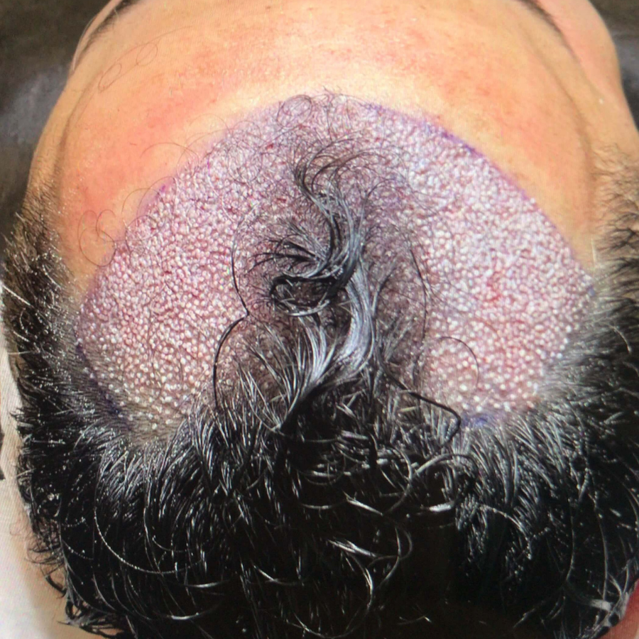 lenahair transplant dhi trassiz sac ekimi