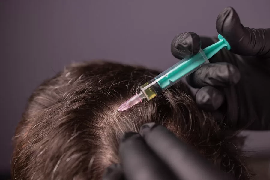 sac mezoterapisi nedir jpg