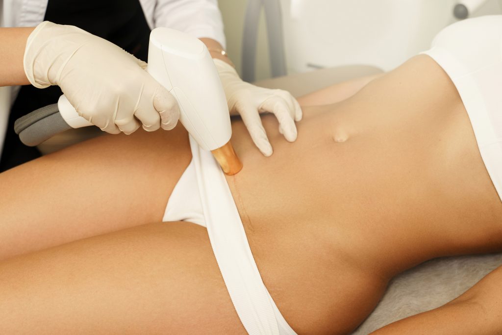 alsancak genital bölge lazer epilasyon