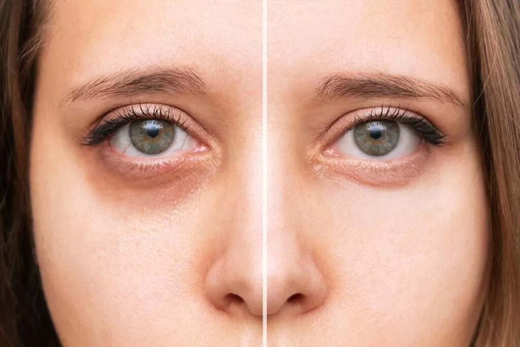 gözaltı rejuvenasyonu kimler İçin uygundur