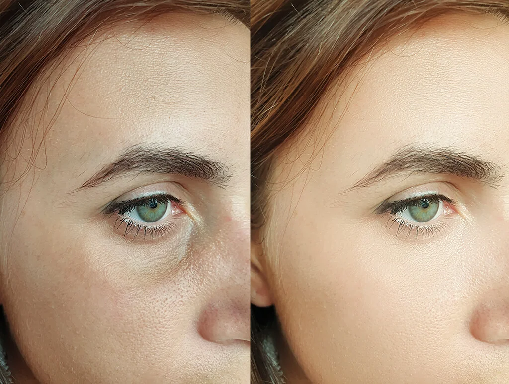 gözaltı rejuvenasyonu nedir daha genç bir görünüm nasıl sağlanır