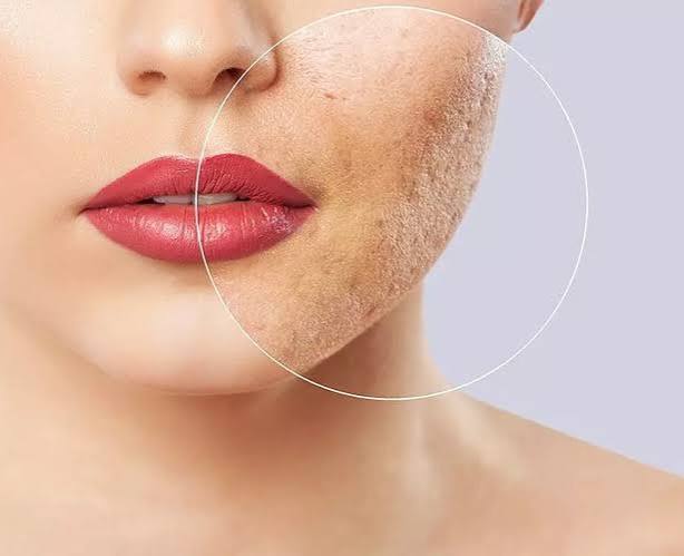 rejuvenasyon nedir cilt yenileme ve canlandırma nasıl yapılır