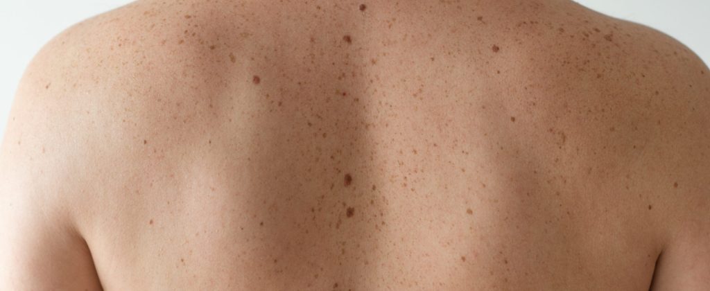 Checking benign moles. Close up detail of the bare skin on a man back with scattered moles and freckles. Pigmentation. Birthmarks on skin