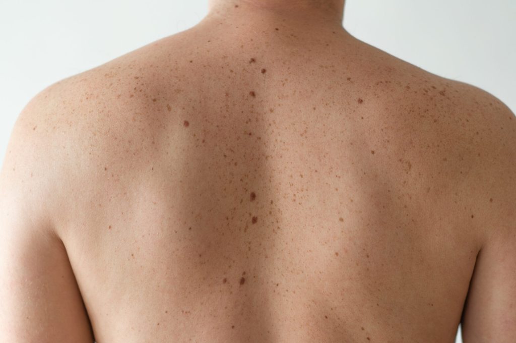 Checking benign moles. Close up detail of the bare skin on a man back with scattered moles and freckles. Pigmentation. Birthmarks on skin